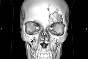 Дефект костей свода черепа в левой лобно-орбитальной области