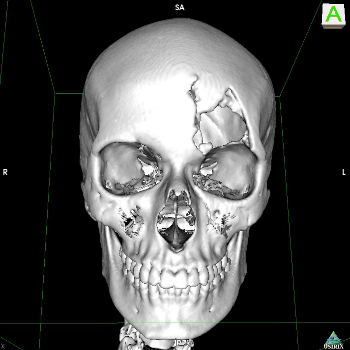 Дефект костей свода черепа в левой лобно-орбитальной области