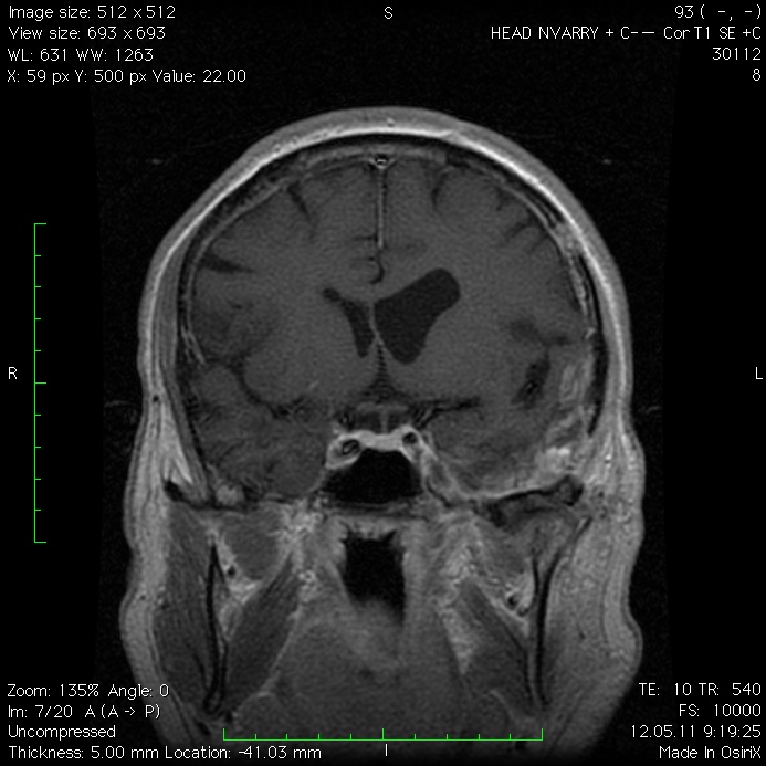 Менингиома средней черепной ямки. Менингиома передней черепной ямки кт. Менингиома головного мозга рентген.