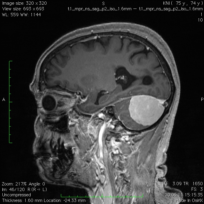 После операции менингиомы головного мозга