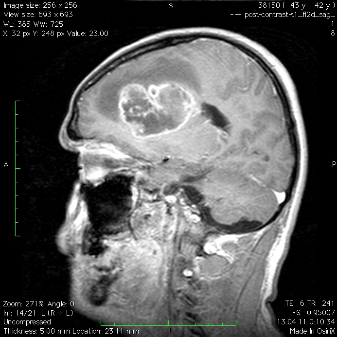 Объемное образования мозга мкб. Опухоль мозга глиобластома. Опухоль головного мозга глиобластома 4. Неопластическая опухоль головного мозга. Онкология глиобластома.