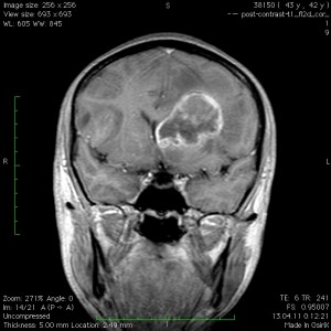 Глиобластома головного мозга фото мрт симптомы