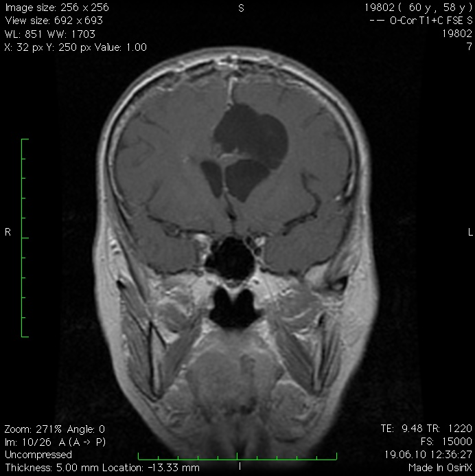 После операции менингиомы головного мозга. Фалькс менингиома кт. Фалькс менингиома мрт. Менингиома серпа мозга кт.