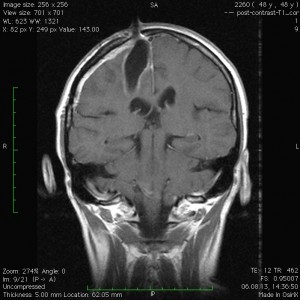 метастаз рака в головной мозг