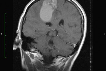 метастаз рака в головной мозг