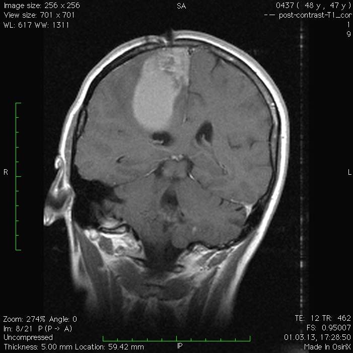 Метастазы в мозгу форум. Кистозные метастазы головного мозга кт. Метастазы в головном мозге на мрт с контрастом. Метастазы головного мозга МСКТ. Кистозные метастазы головного мозга мрт.