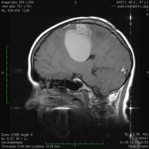 удаление метастаза рака в головной мозг