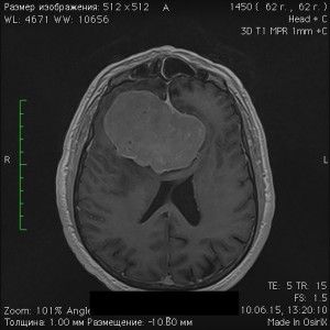 https://dr-gavrilov.ru/lechenie-udalenie-opuholi-golovnogo-mozga/vnutrimozgovie/udalenie-astrocitomy/