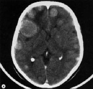 Метастазы рака в головном мозге
