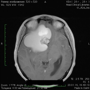 MRI AX KLOK preop1