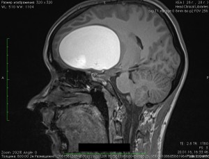 MRI SAG KLOK preop