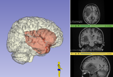 Глиома островкой доли. Удаление астроцитомы правой островковой доли, распространяющейся на правые лобную и височные доли.