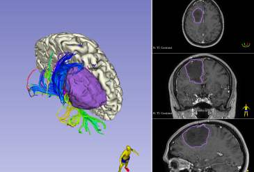 Внутримозговая опухоль правой лобной доли. Удаление астроцитомы G4.